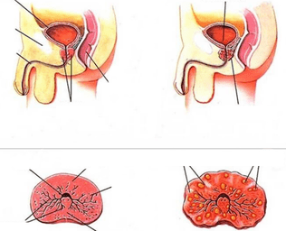 próstata normal e prostatite crónica