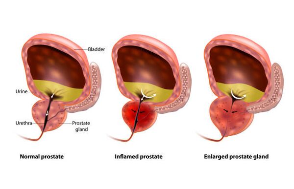 a prostatite é unha inflamación da glándula prostática