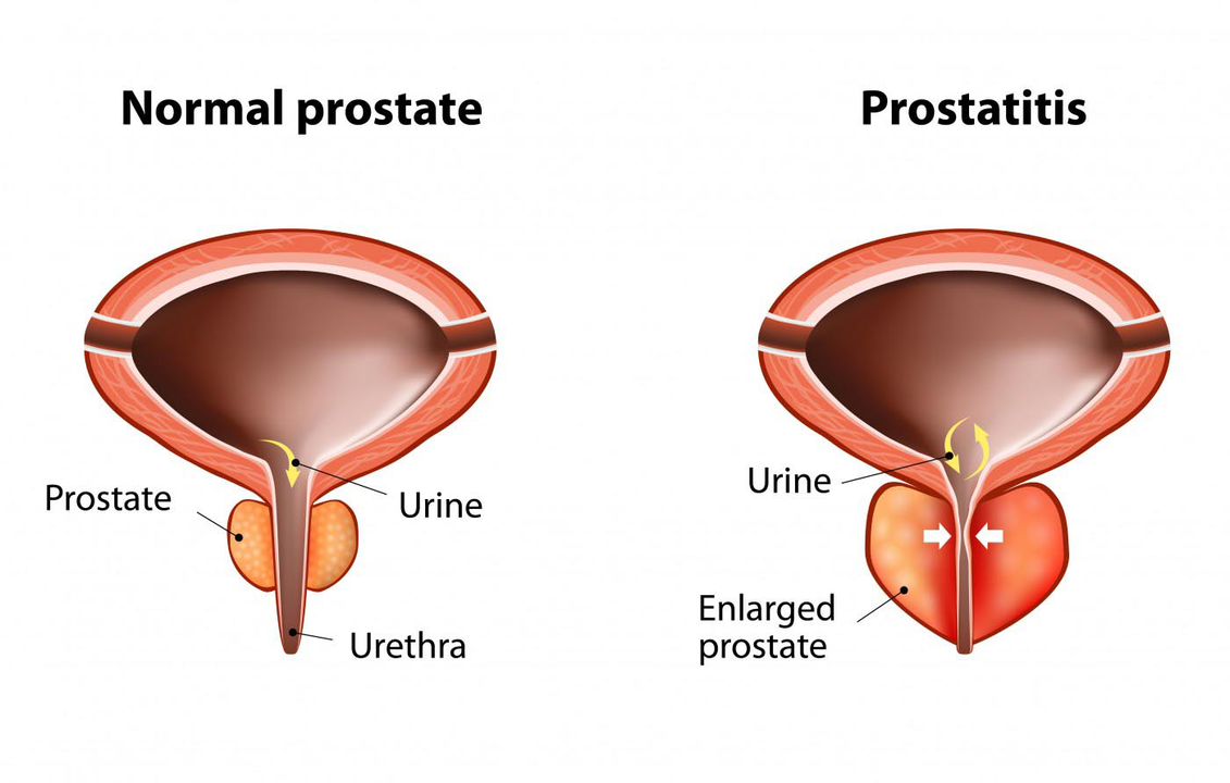 Próstata normal dun home san e inflamación da glándula prostática con prostatite